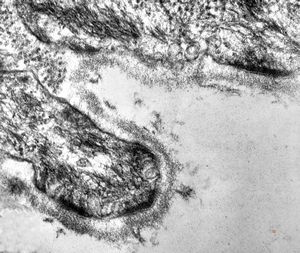 F, 1y. | epidermolysis bullosa … dystrophic form F, 1y. | epidermolysis bullosa … dystrophic form